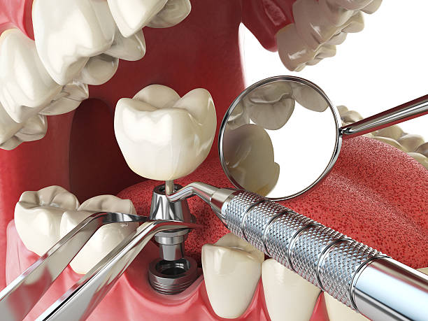 Best Emergency Root Canal Therapy in Baldn, WI